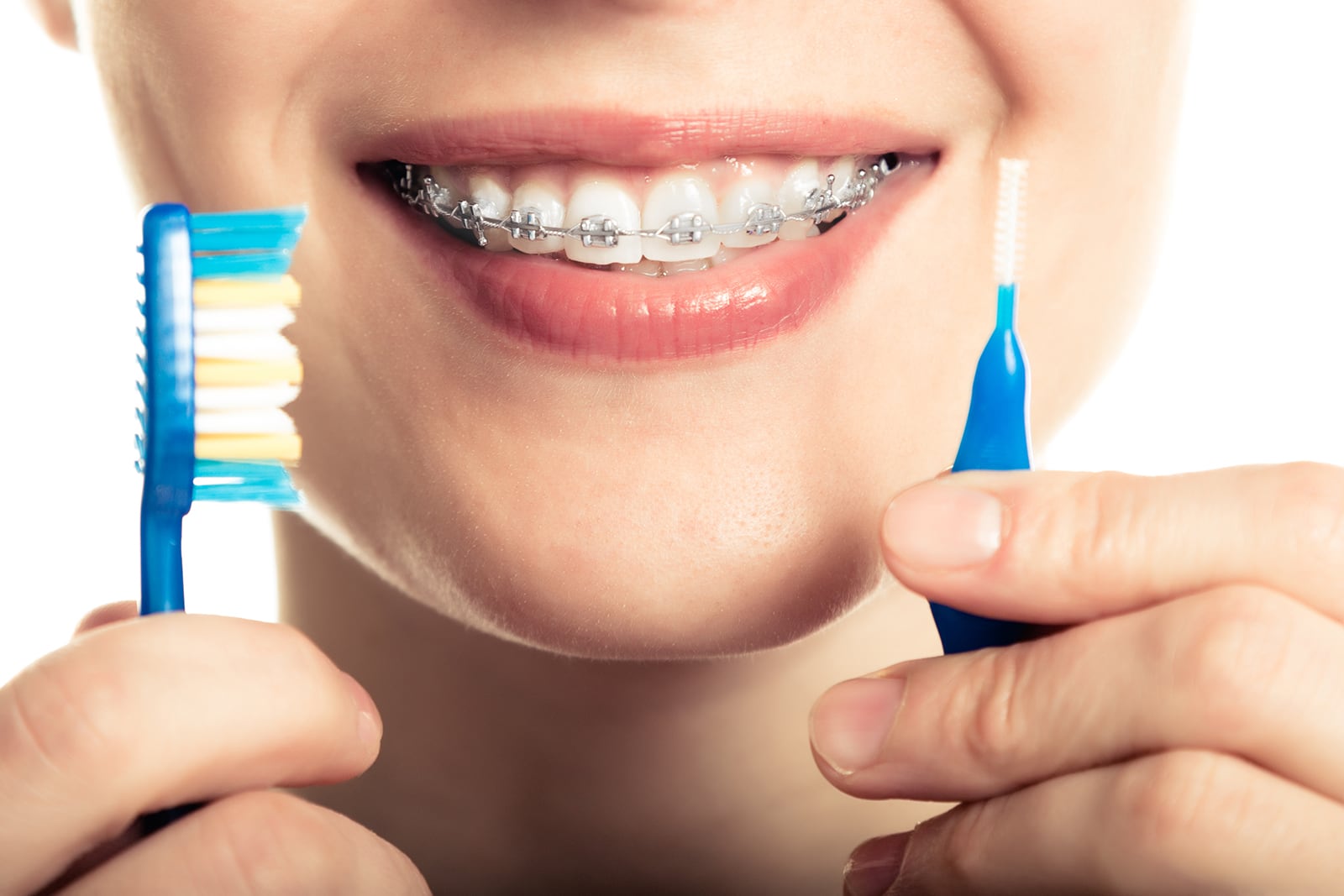 Know About the Procedure for Dental Braces 3