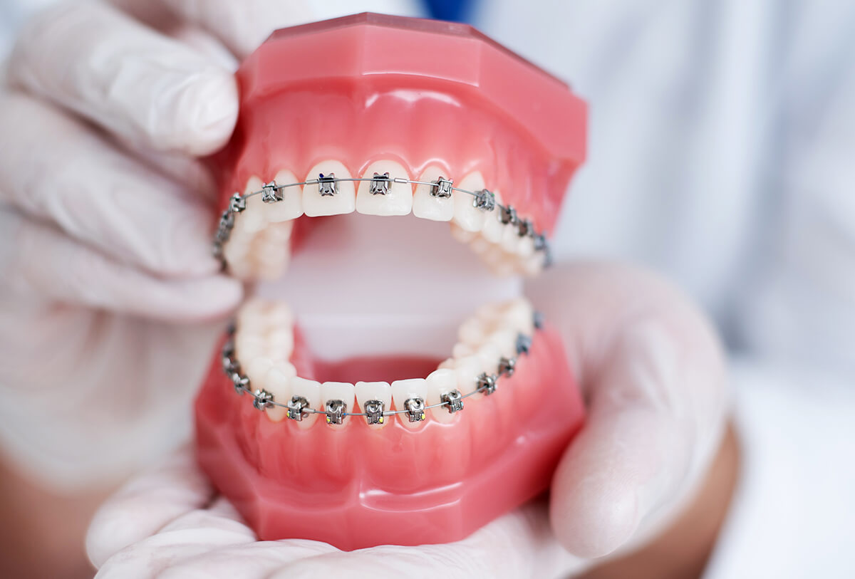 Know About the Procedure for Dental Braces 4