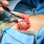 Ileostomy Surgery for Medical Students